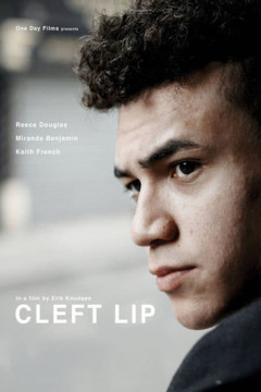 კურდღლის ტუჩი ქართულად - Cleft Lip
